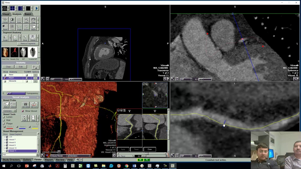 Coronary post processing upon Vitrea 6 ,,,, video 1