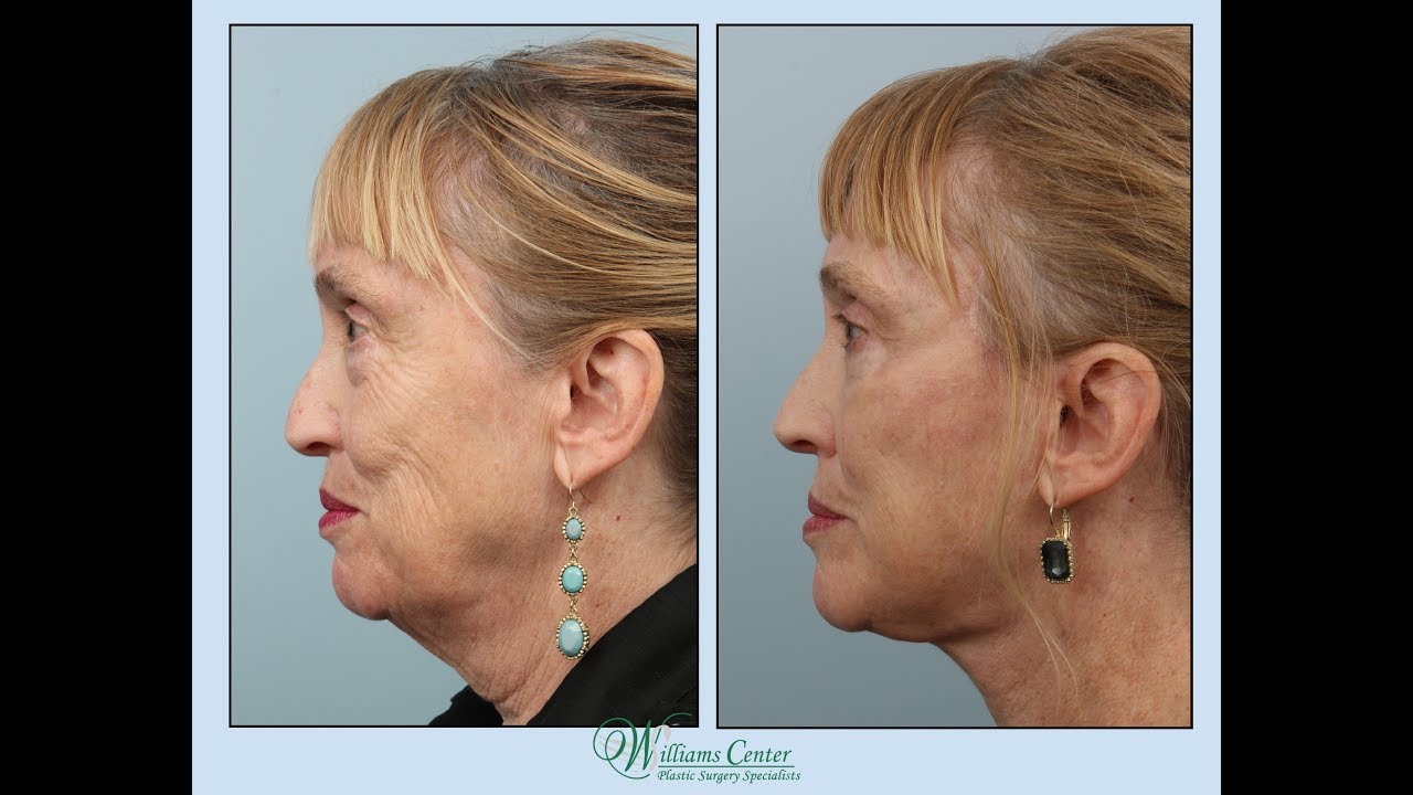 Facelift Experience by Nancy with Dr. Edwin Williams