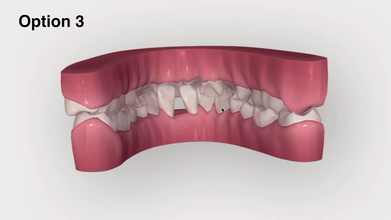 ABO Case Report-Invisalign｜【Chris Chang Ortho】CC521