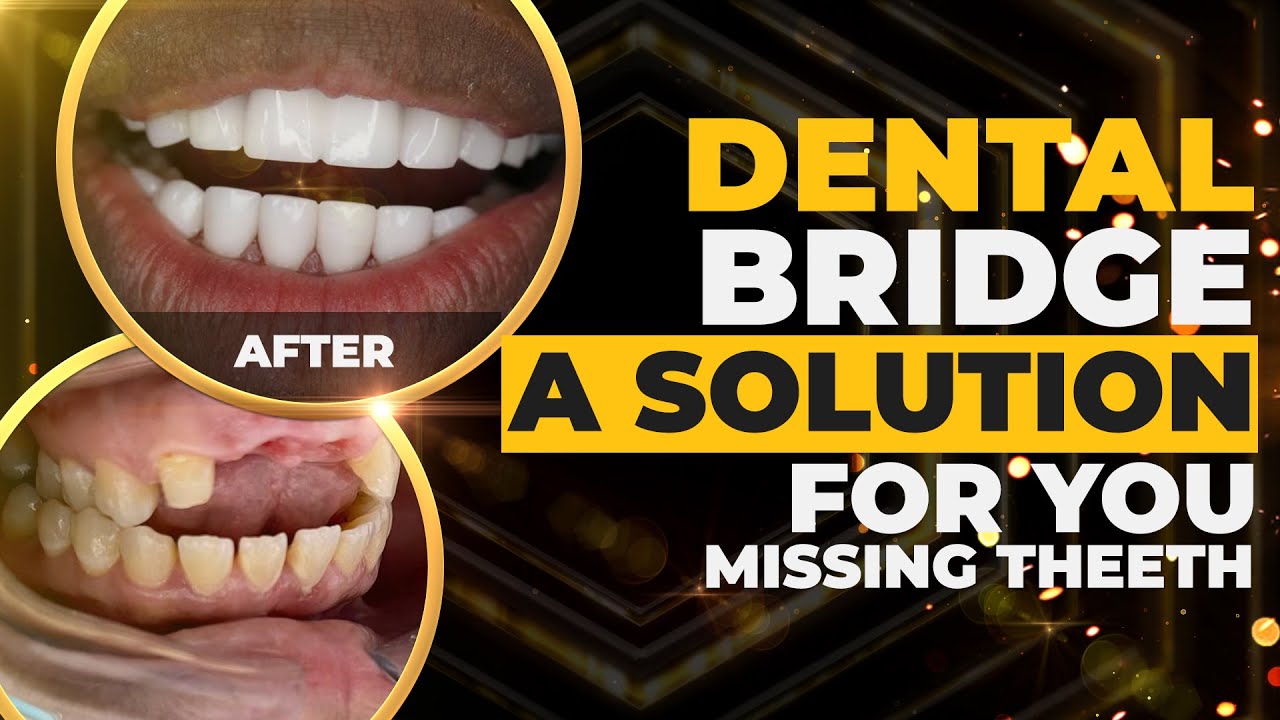 Missing teeth? don't worry