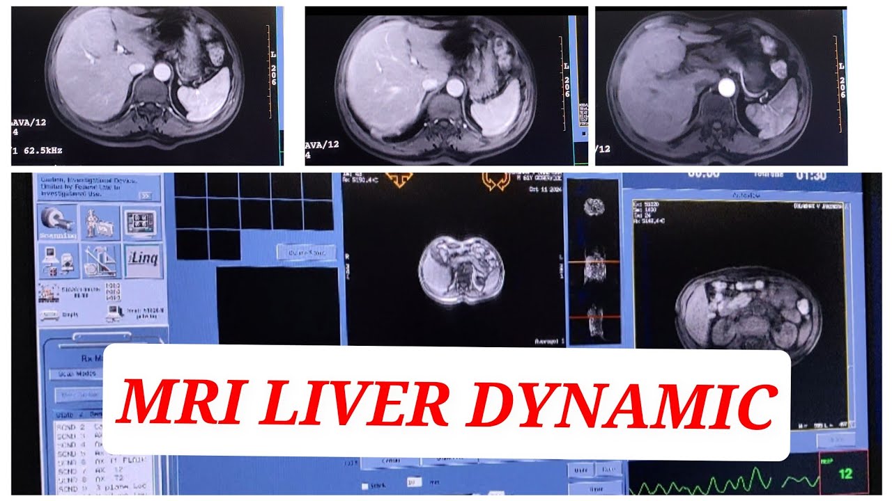 MRI Liver Triphasic | Dynamic Liver.