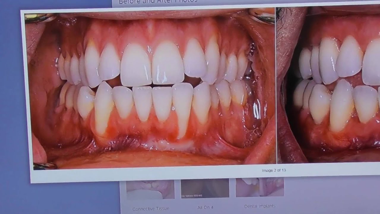 Gum Recession & Orthodontics: They're Connected!