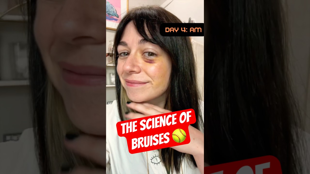 What is a BRUISE? 🥎 watch my black eye heal