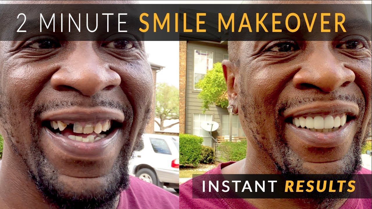 2 Minute Smile Makeover - Dental Veneers by Brighter Image Lab - No Cosmetic Dentist Needed