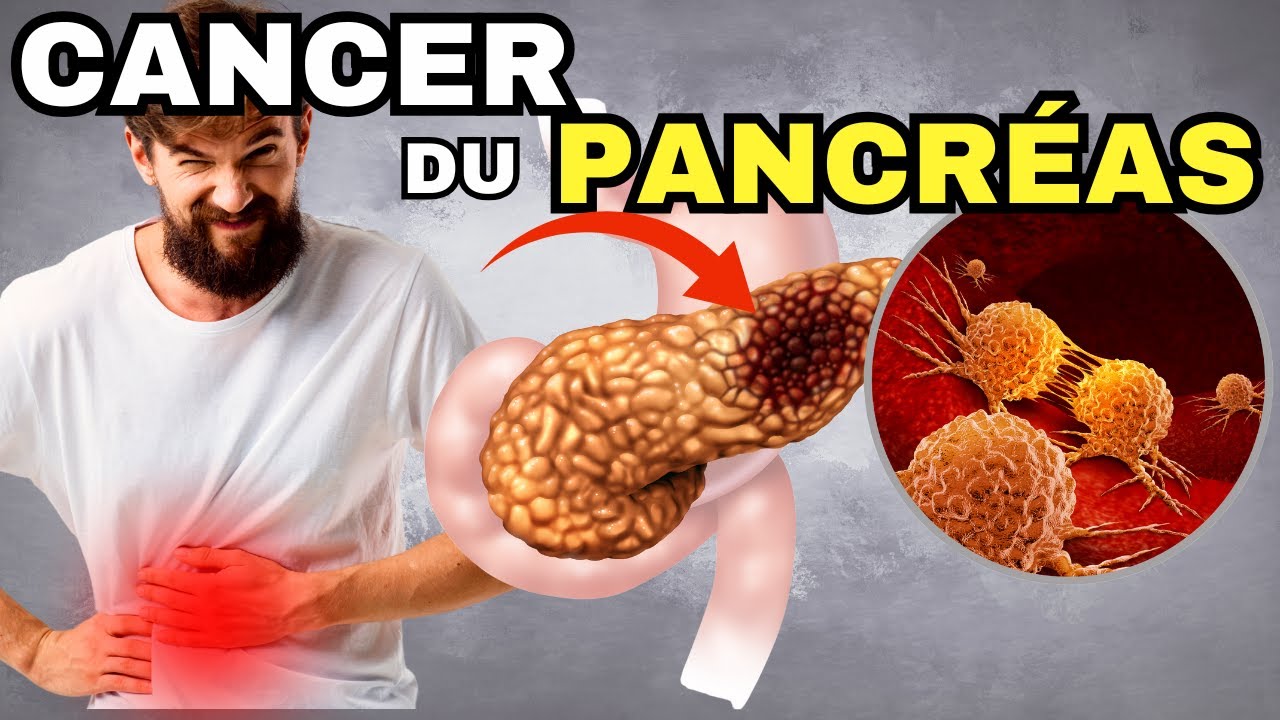 SYMPT&Ocirc;MES les plus fr&eacute;quents du CANCER DU PANCREAS