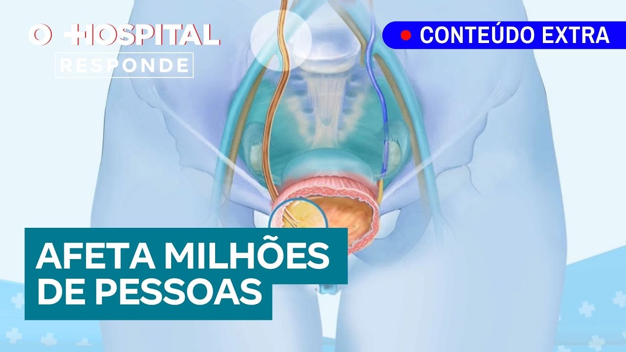 Pedras nos rins: tudo o que você precisa saber | O Hospital Responde