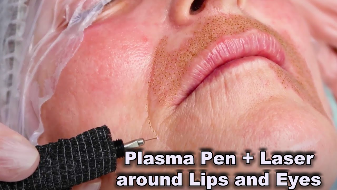 Plasma Pen Fibroblast treatment in combination with Laser for wrinkles around lips and eyelids