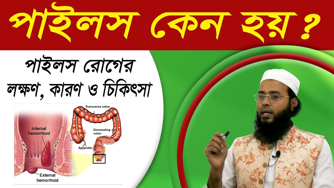 পাইলসের হোমিও চিকিৎসা | পাইলসের লক্ষণ | পাইলসের হোমিও ঔষধ | Piles Treatment - Medicine | সুস্বাস্থ্য