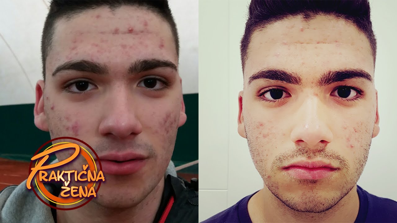 Praktična žena - Rešavanje problema akni na licu