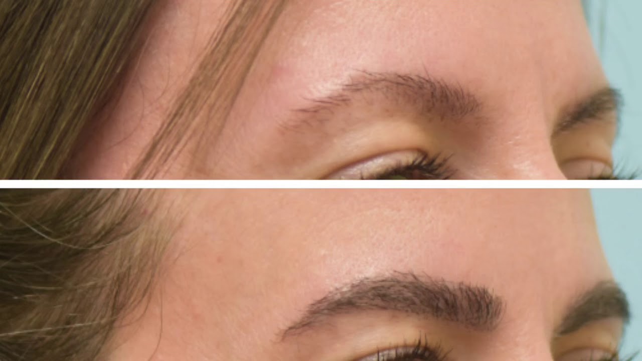 Dallas Eyebrow Transplant HD Closeup Video