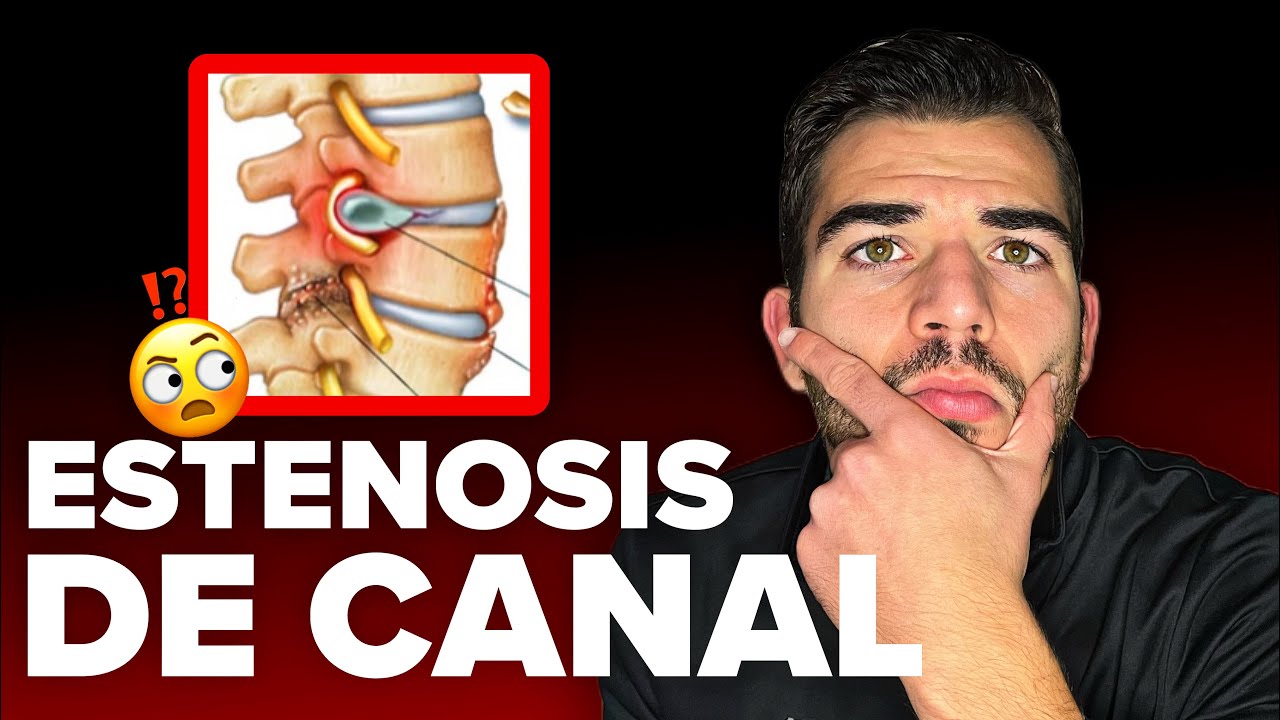 ¿Tienes Hernia y Estenosis? Evita la Operación con esta SOLUCIÓN REAL