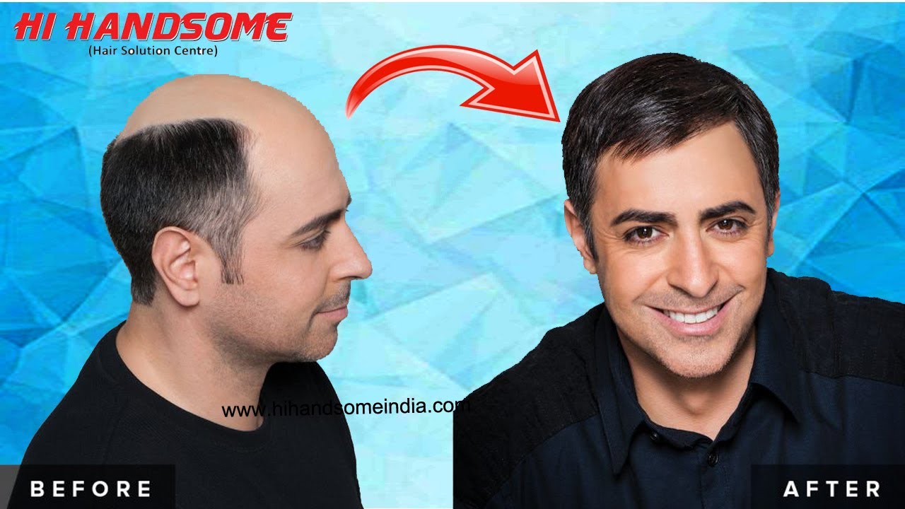 Hair Patch Video | Hair Patch in Purnia | Hair Wig in Purnia | Hair Transplant in Purnia