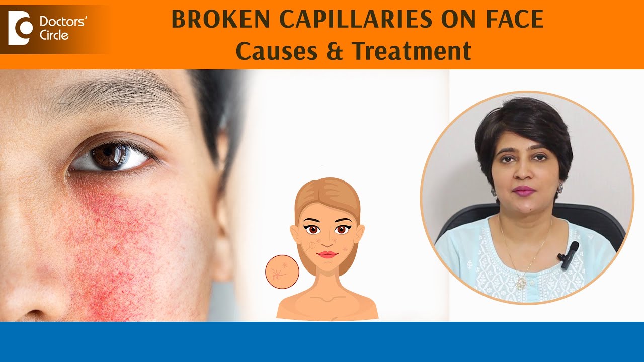 BROKEN CAPILLARIES on FACE! |Skin REDNESS | BLOOD VESSELS on face - Dr.Rasya Dixit | Doctors' Circle