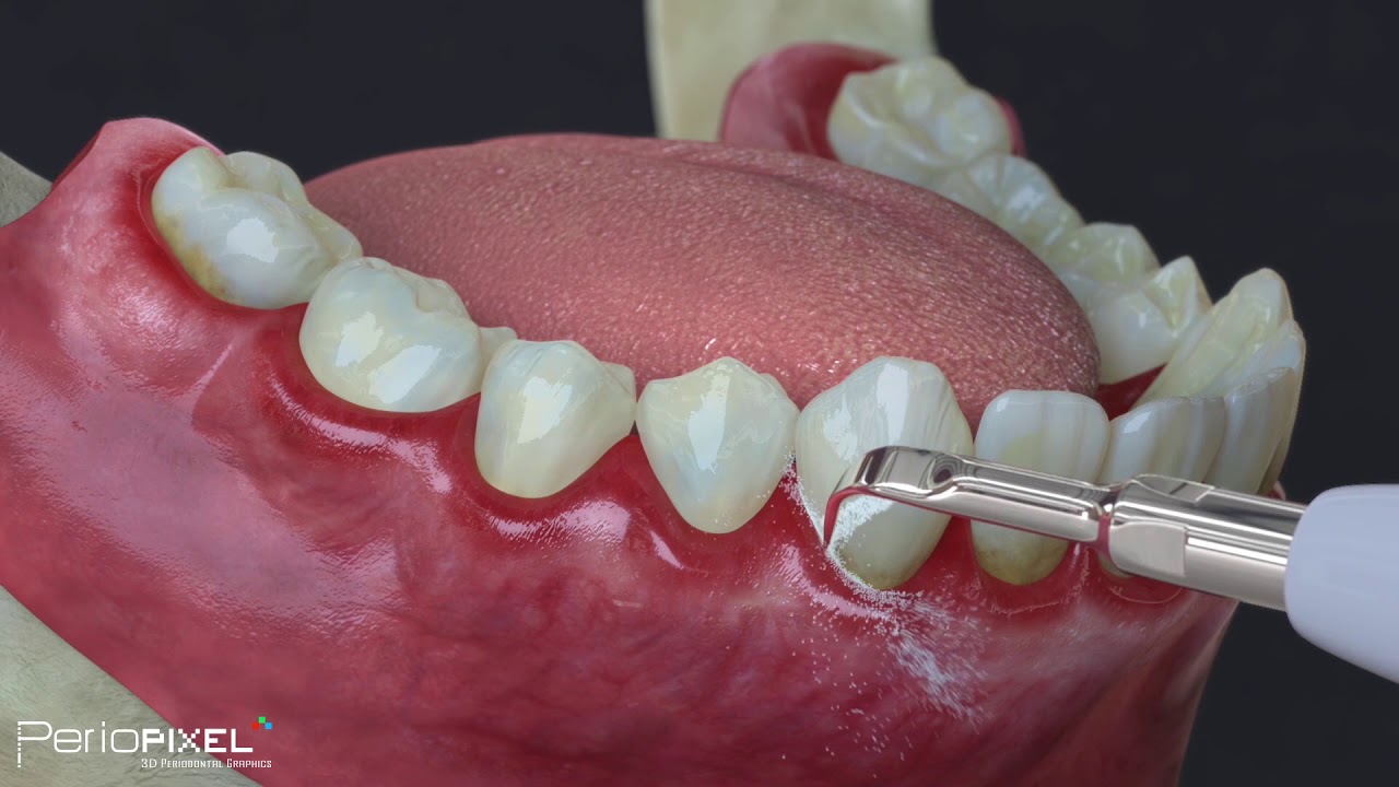 Tratamiento periodontal b&aacute;sico para pacientes (gingivitis y periodontitis) - Tr&aacute;iler