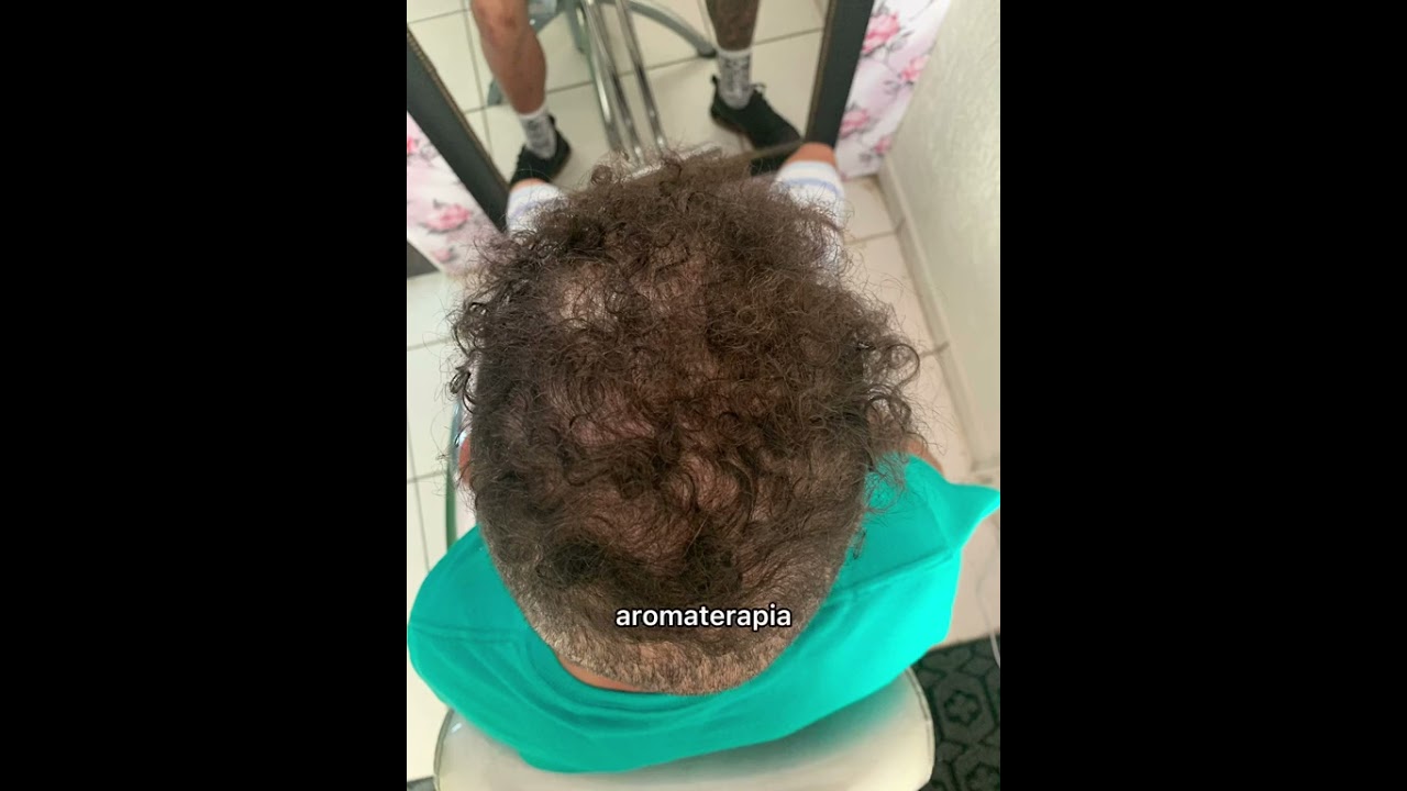 Resultado de tratamento capilar de alopecia androgen&eacute;tica masculina #calvice #cabelo #CALVO