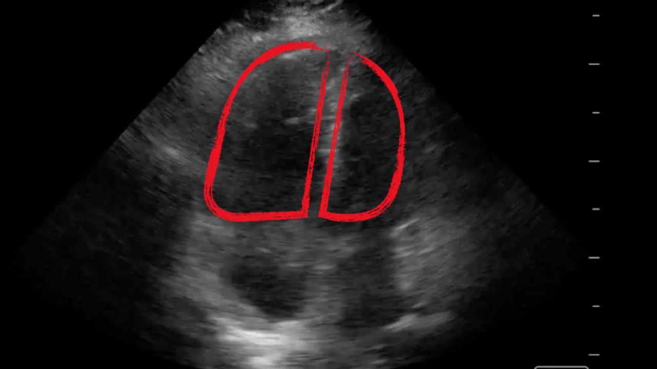 McConnell's Sign - Point-of-Care Echo
