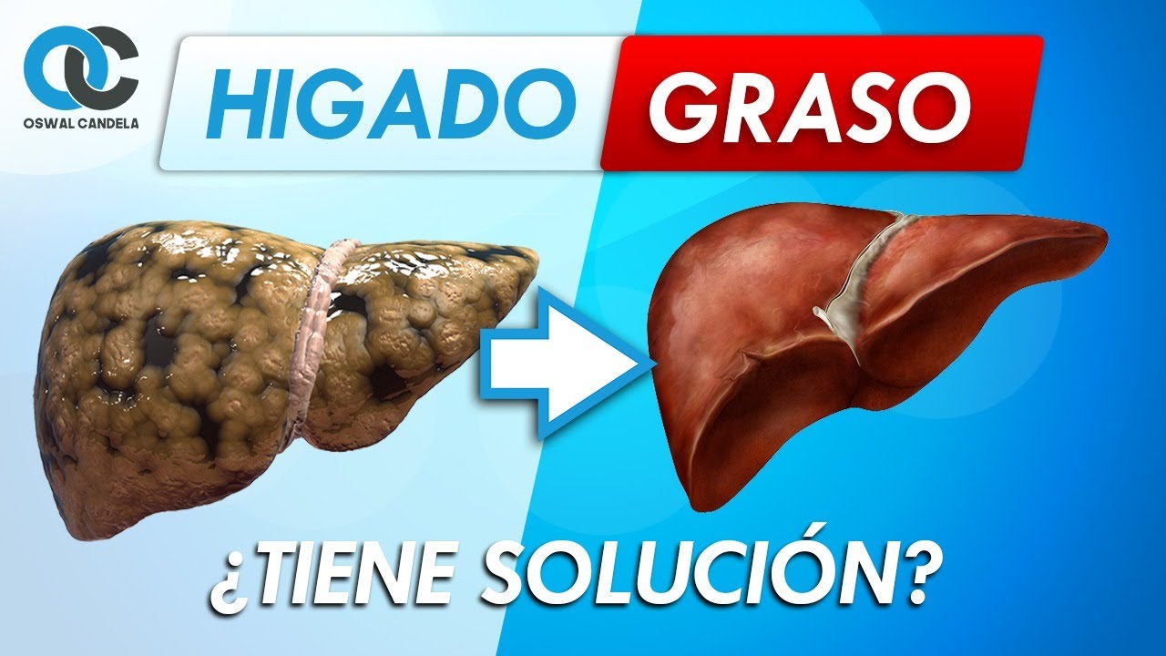 Hígado graso ¿lo sabías?