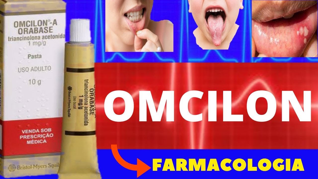 OMCILON - PARA QUE SERVE, COMO USAR, COMO FUNCIONA, EFEITOS COLATERAIS - TRIANCINOLONA ACETONIDA