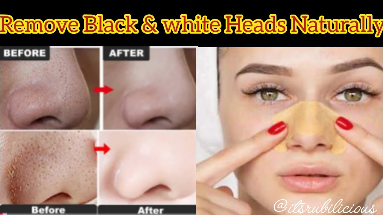 How to Remove Blackheads & Whiteheads Naturally | Best Home Remedies for clear Skin @itsrubilicious