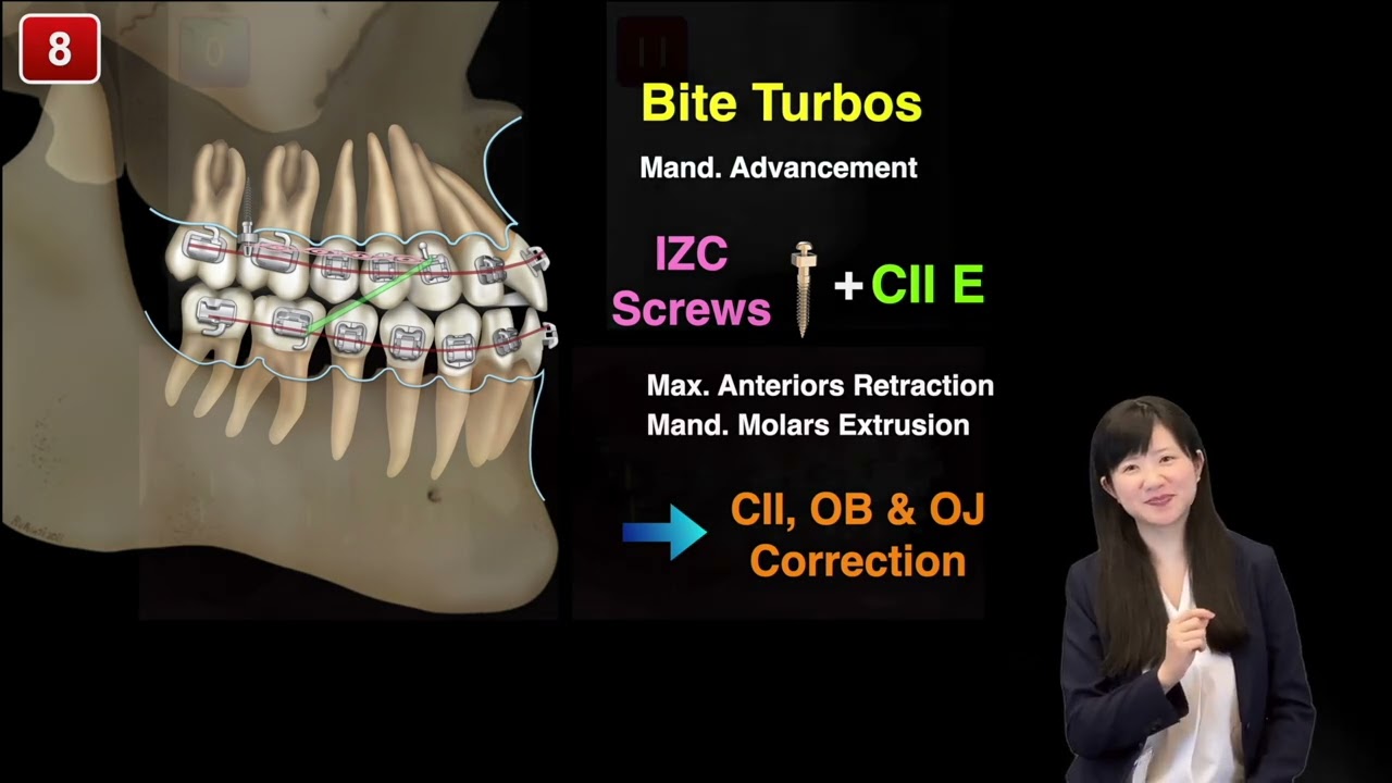 AJODO CC 2023: Class II Malocclusion with 14mm OJ Treated with U7 Extractions and Bone Screws｜CC754