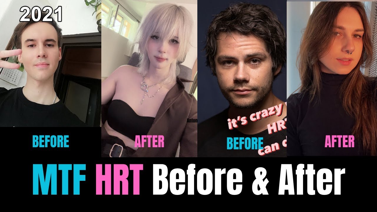 MTF HRT Before & After – The Power of Estrogen in Real Life