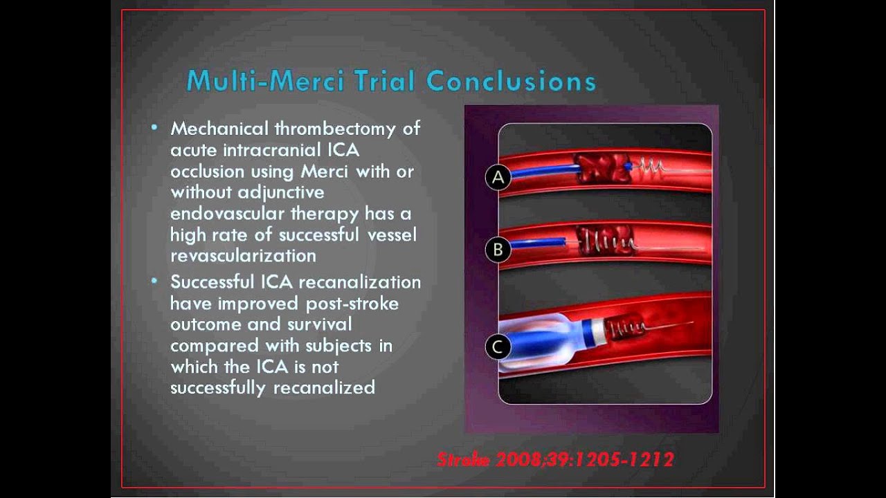 Internal Medicine Grand Rounds April 8 2015 Introduction to Neurointerventional Surgery