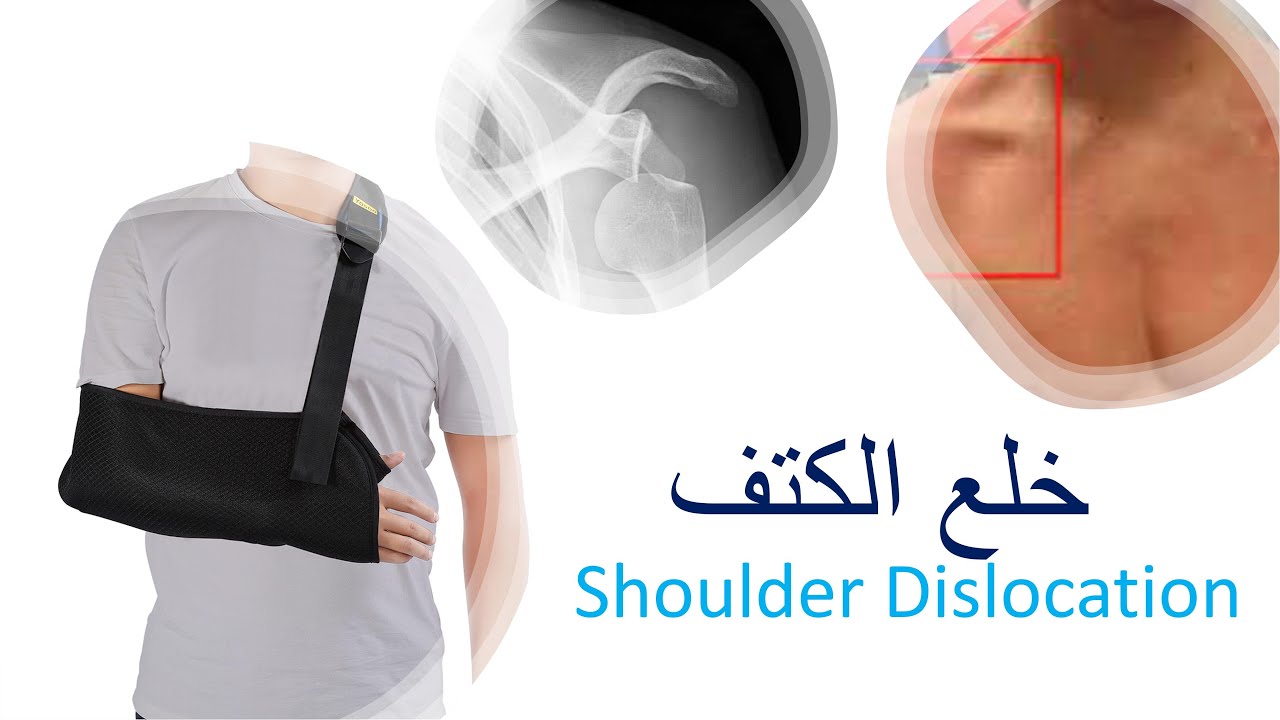 Shoulder dislocation / خلع مفصل الكتف