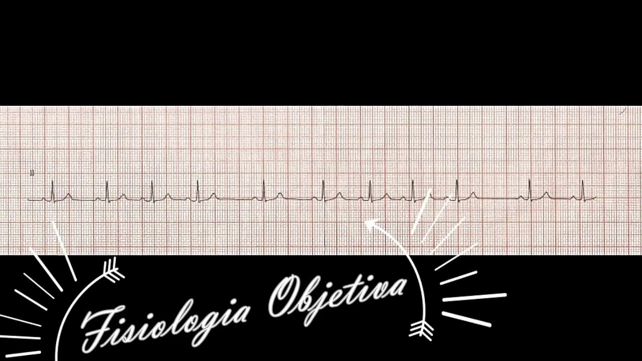 Frequ&ecirc;ncia Card&iacute;aca em um ECG de ritmo irregular