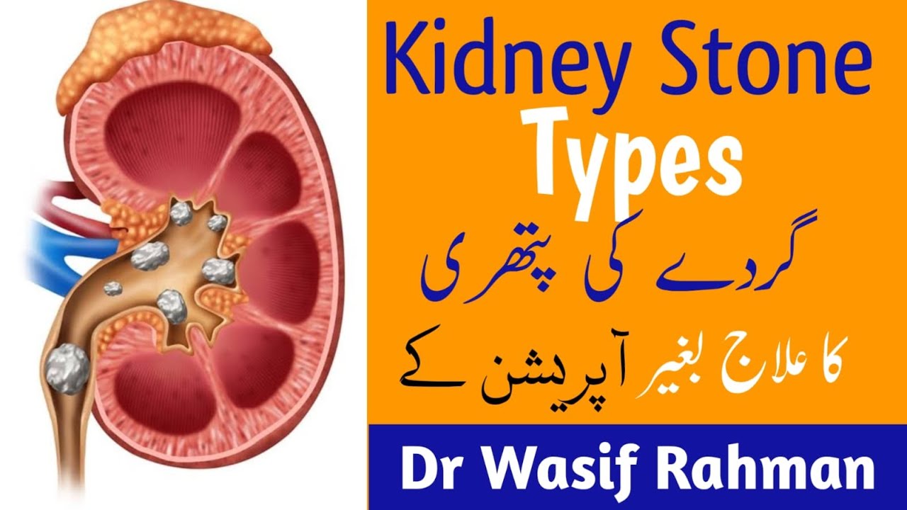 Kidney stone | Treatment | گردے کی پتھری کا علاج | Dr Wasif Rahman
