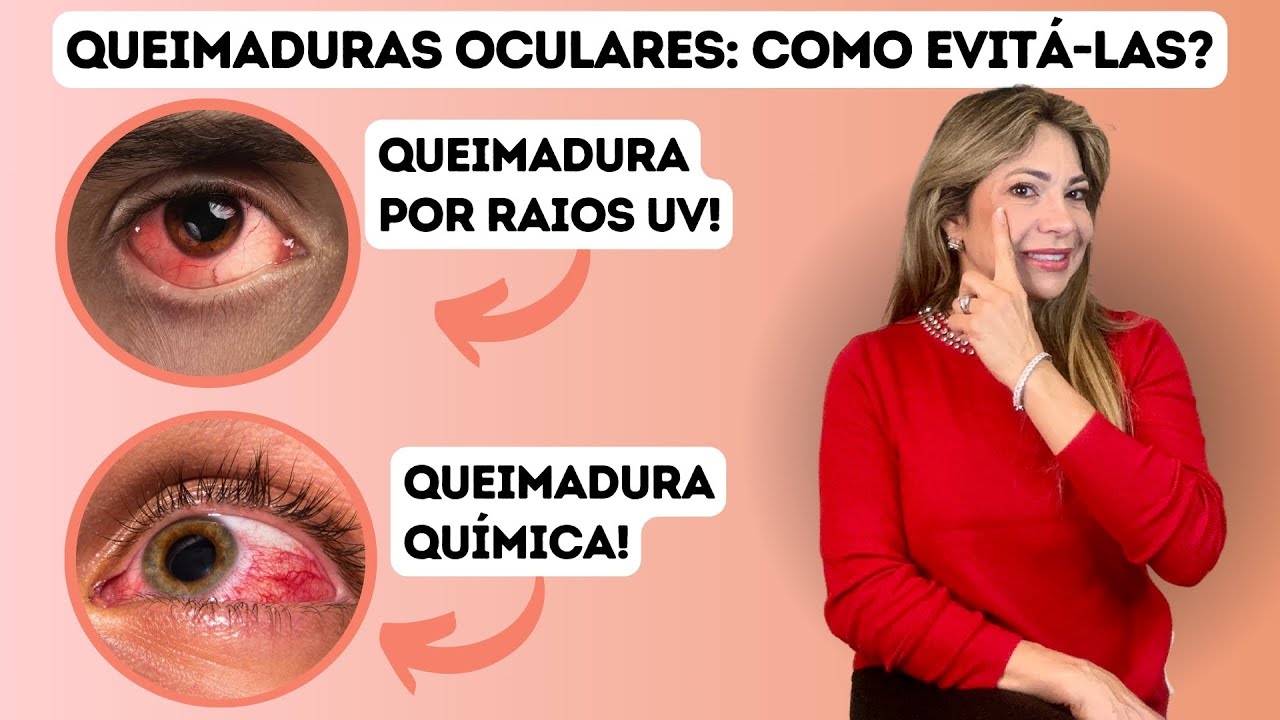 Como Se Prevenir De Queimaduras Oculares!!