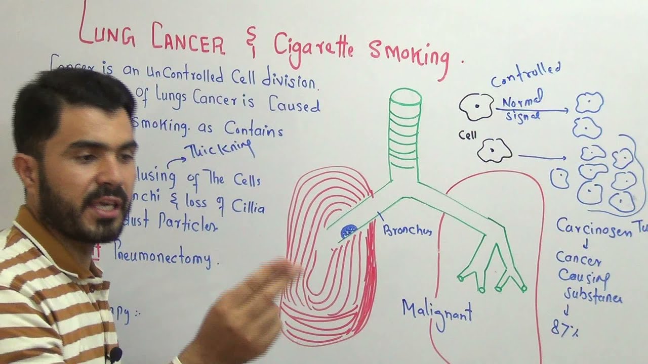 L-10 Lung cancer and Cigarette smoking || causes and symptoms of Lungs cancer