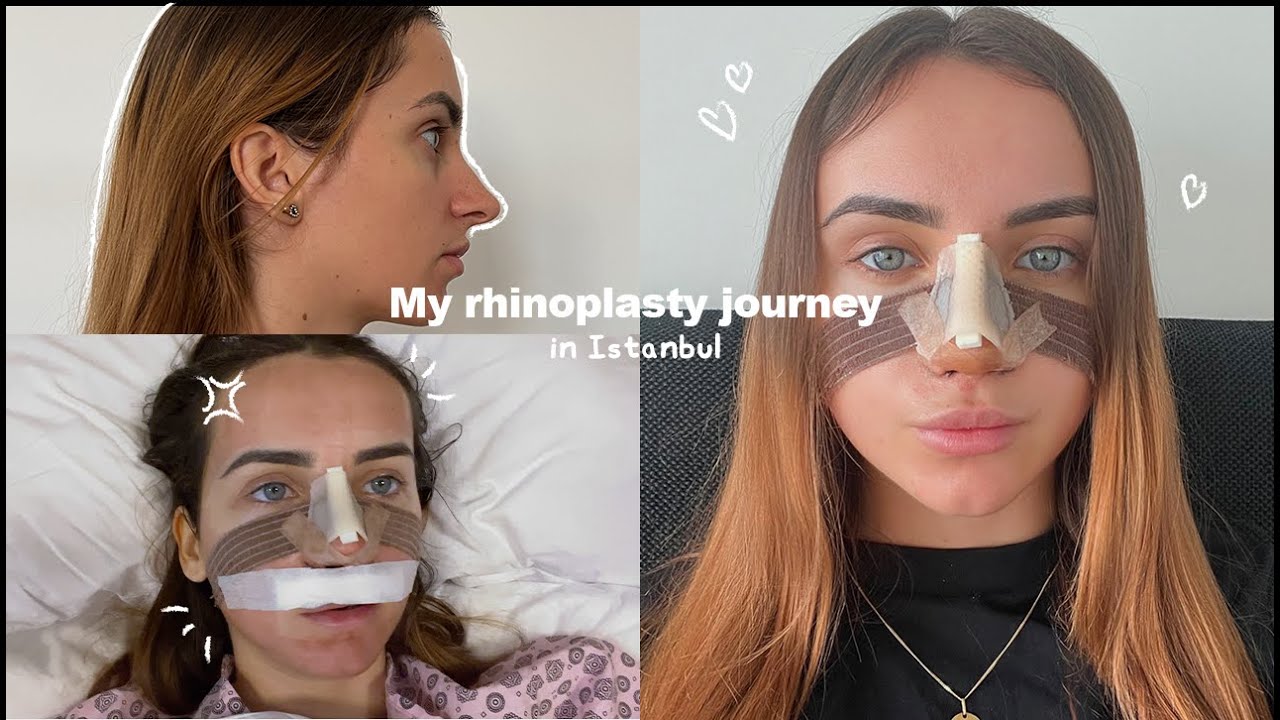 MY NOSE JOB IN TURKEY WITH THE BEST SURGEON !!