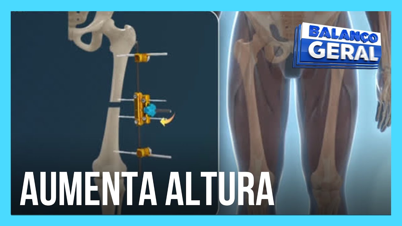 Cirurgia estética aumenta altura, mas pode causar dores
