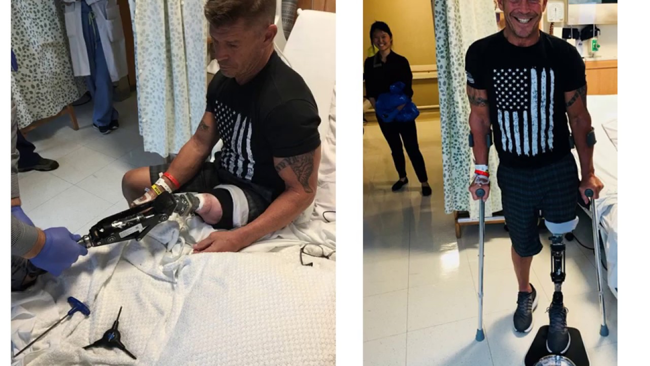 Osseointegration Amputation Reconstruction