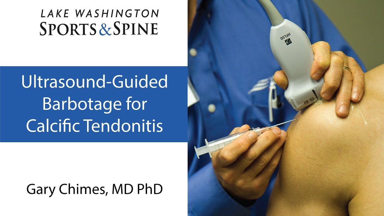 Ultrasound-guided Barbotage for Calcific Tendinitis