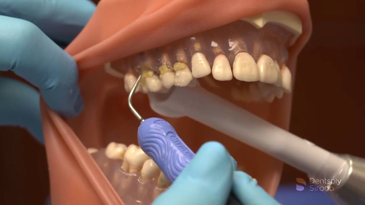 Cavitron® Powerline® 10 30KUltrasonic Insert | Dentsply Sirona