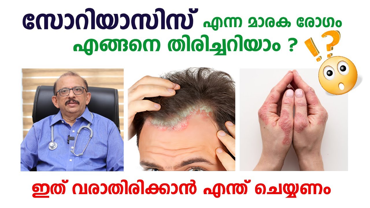 സോറിയാസിസ് എന്ന മാരക രോഗം നേരത്തെ തിരിച്ചറിയാം /Arogyam