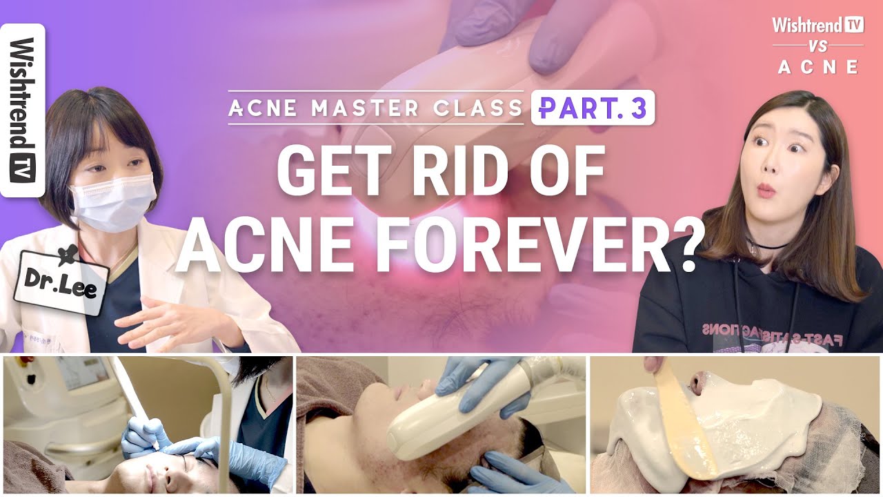 All About Dermatologist-Approved Acne Treatments: From Oral Medication to Lasers | Part 3