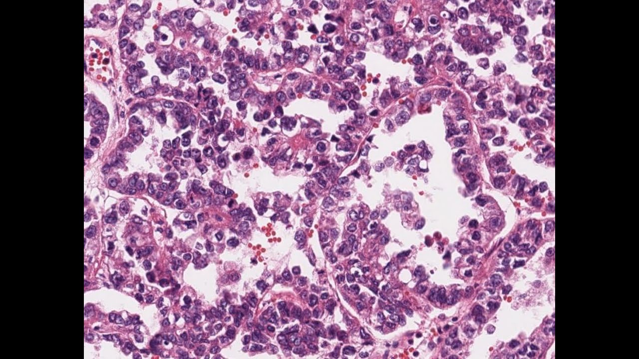 Digital Surgical Pathology 35 Mixed Serous and Clear Cell CA  Endometrium