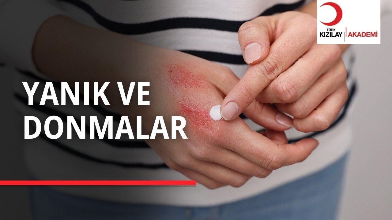 Yanıklarda ve Donmalarda Sakın Bunu Yapmayın!