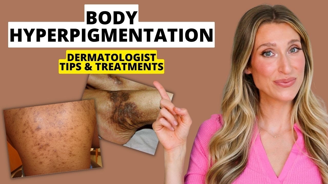 Dermatologist Explains Body Hyperpigmentation: What Causes It, Best Treatments, Prevention, & More!