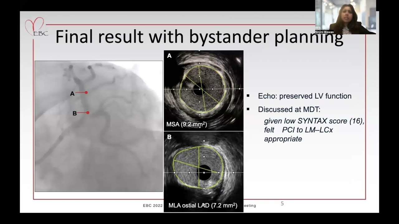 A jailed side-branch wire fracture requiring complex snaring -  Dr Sinjini Biswas