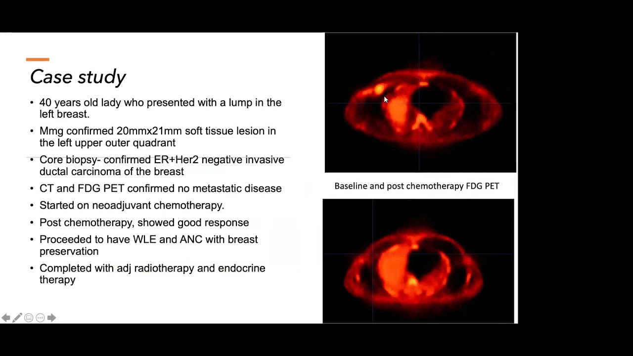 Imperial Science Caf&eacute;: Role of PET scan research in cancer treatment