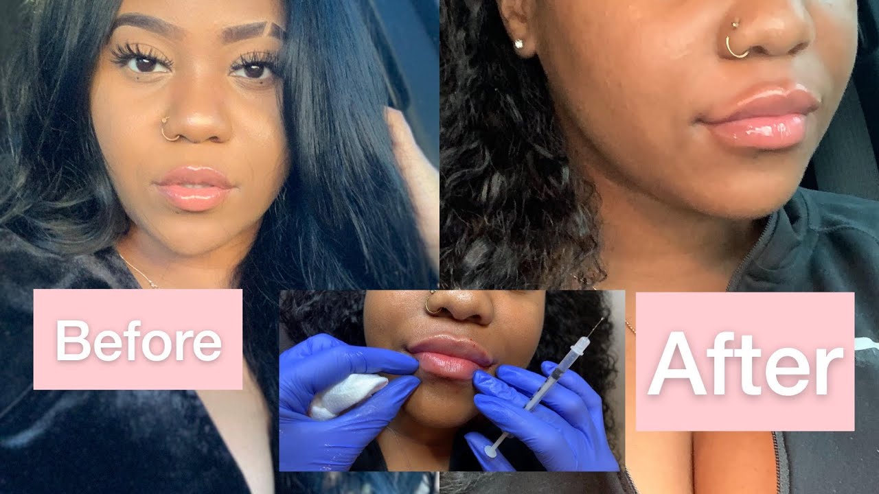 Black Girl/Woman Lip Filler Vlog! + Procedure Juvederm Ultra Plus