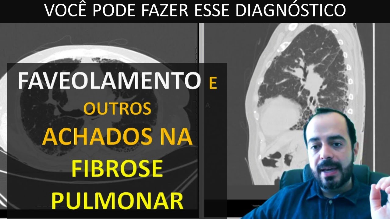 FAVEOLAMENTO NA TOMOGRAFIA - FIBROSE PULMONAR? PACIENTE COM ARTRITE REUMATOIDE.