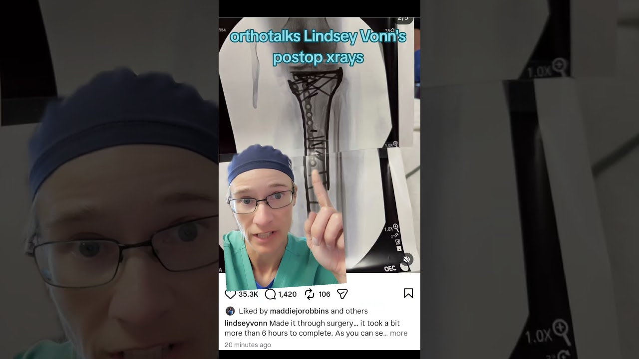 Lindsey Vonn's post op films reveal just how bad the injury is #orthotalks
