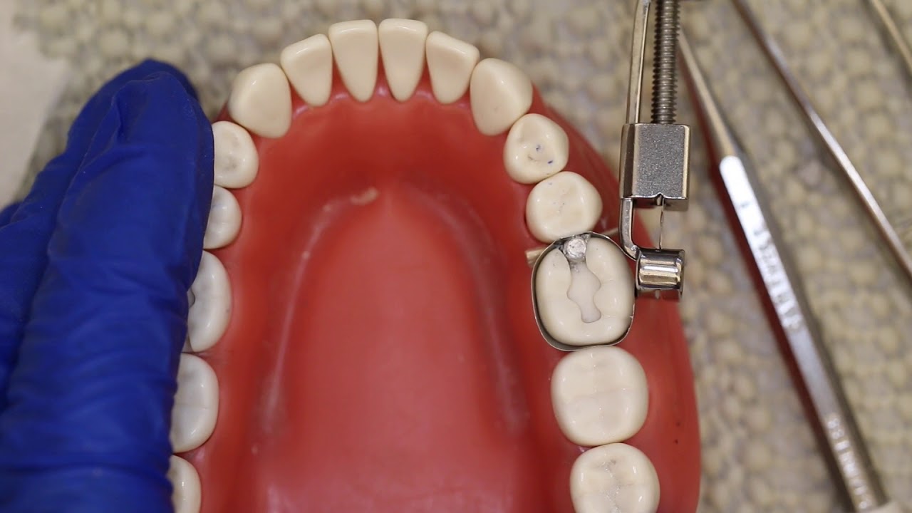 Pack And Condense Amalgam