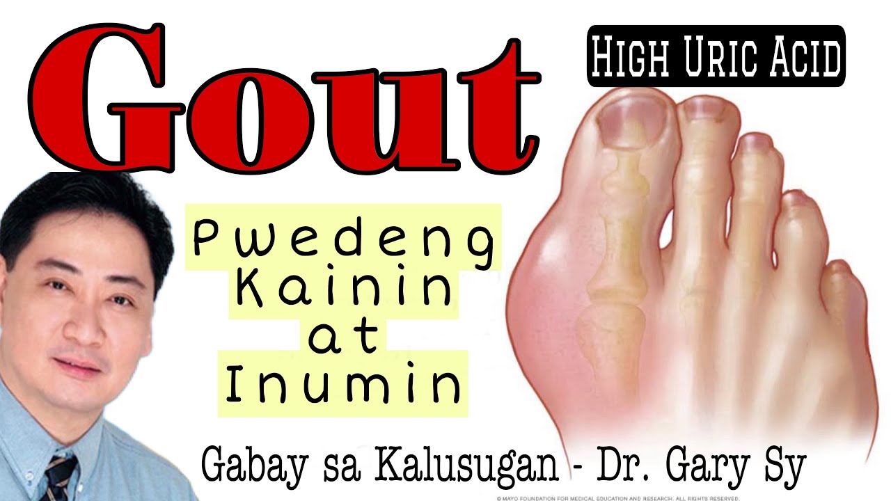 GOUT: PWEDENG Kainin at Inumin - Dr. Gary Sy