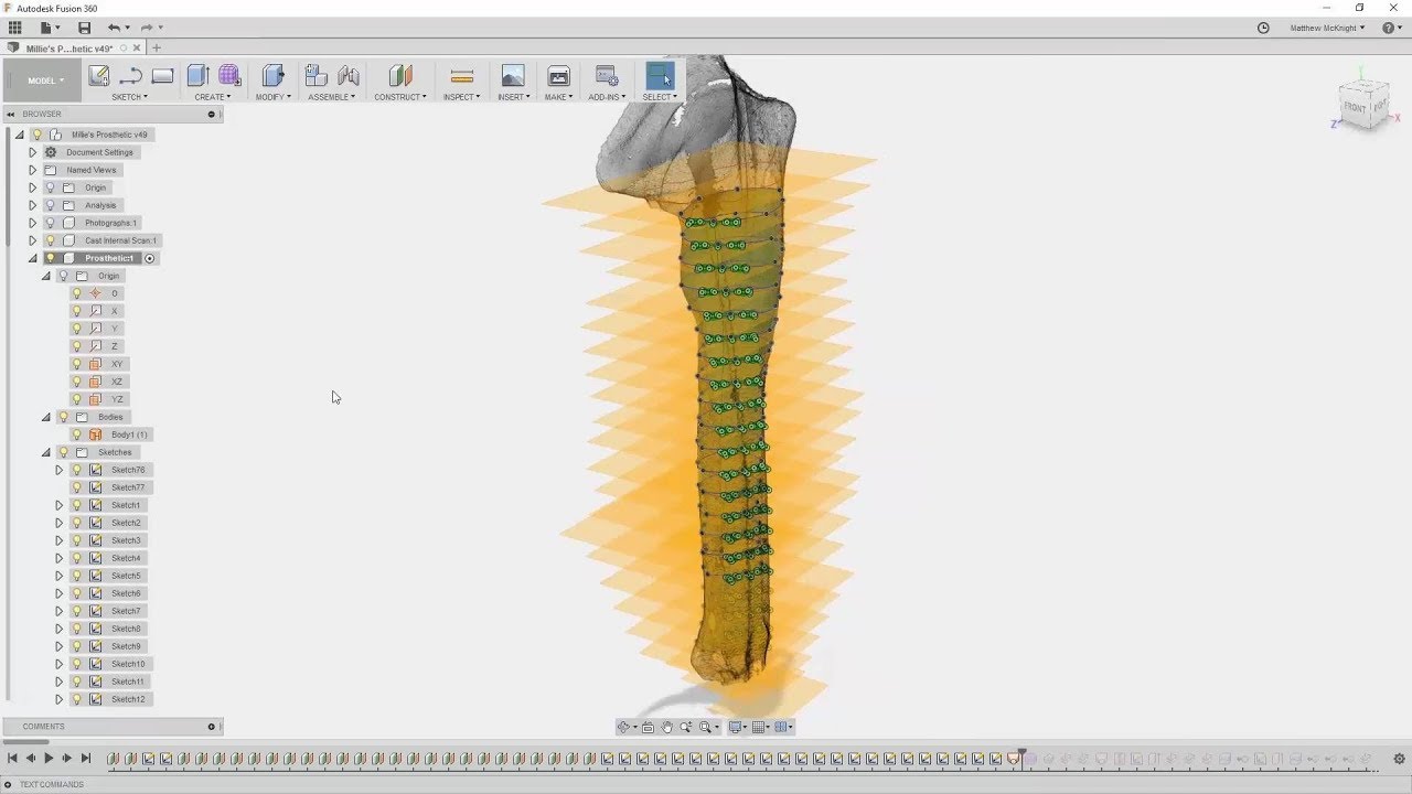 Millie's Prosthetic - How Fusion 360 is breaking down traditional design and manufacturing barriers!