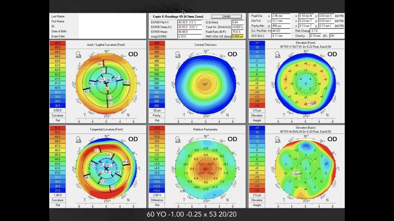 [Online Seminar] George O Waring: Post Refractive IOL Calculations with the Pentacam&reg; AXL